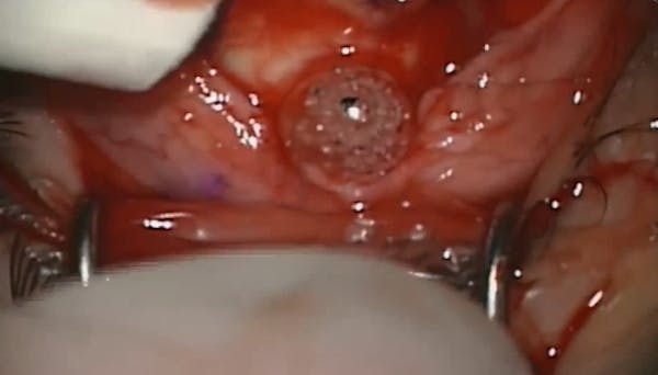Retinaws Vitrex 2023 5 thumbnail