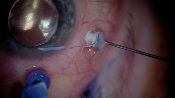 Redetachment with Macular Hole thumbnail