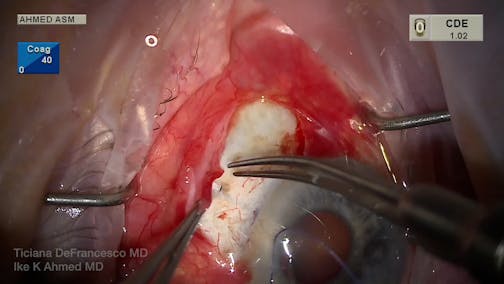 Implantation of a MicroShunt