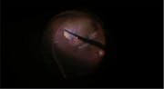 iOCT in a Case of Vitreous Hemorrhage