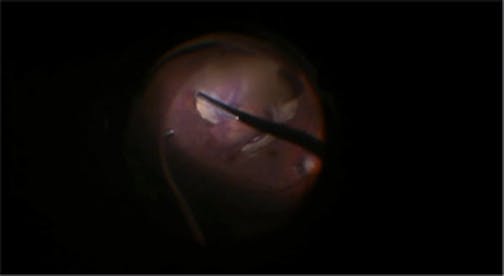 iOCT in a Case of Vitreous Hemorrhage