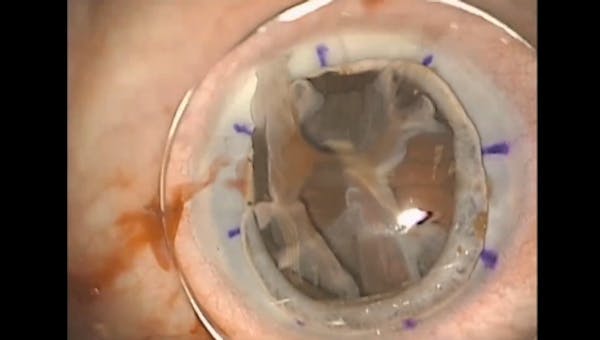 Expulsive Hemorrhage thumbnail