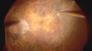 Myopic Macularschisis