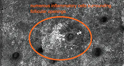 An Introduction to Reflectance Confocal Microscopy image