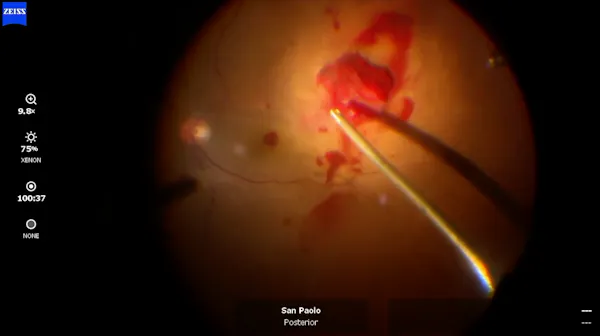 Vitreous Traction thumbnail