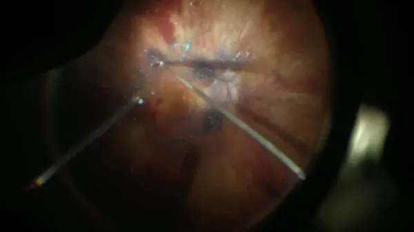 Myopic Macularschisis thumbnail