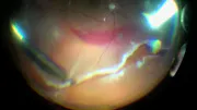 Retinotomy