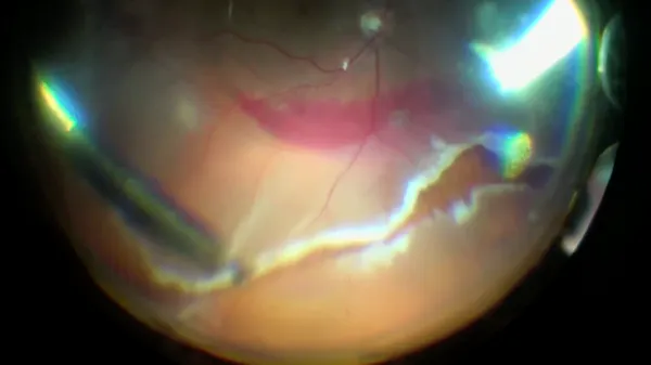 Retinotomy thumbnail