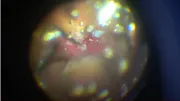 Macular Hole in High Myopia