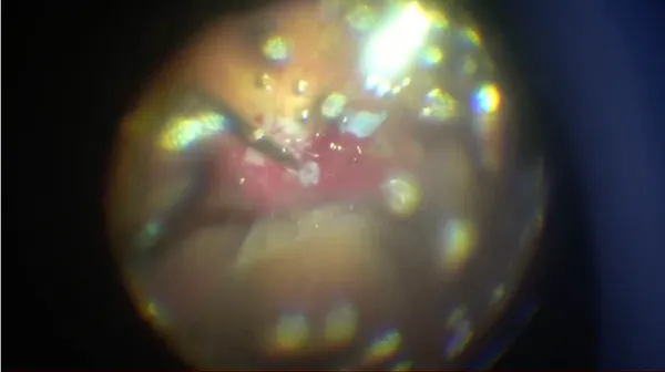 Macular Hole in High Myopia thumbnail