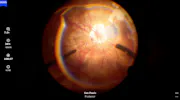 Amniotic Membrane