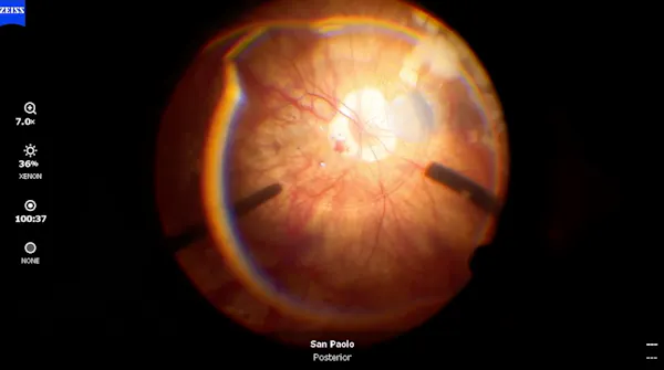 Amniotic Membrane thumbnail