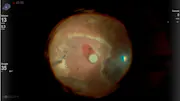 Ganciclovir Implant