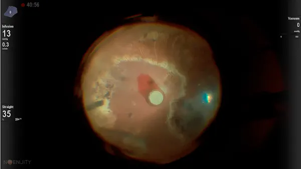 Ganciclovir Implant thumbnail