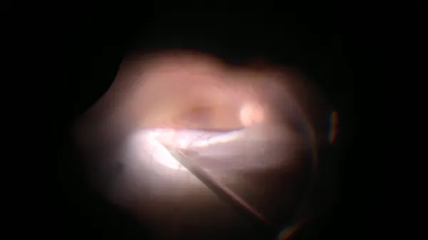 Macular Fold thumbnail