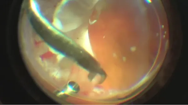 Subretinal Oil thumbnail