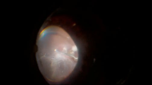 A Severe Case of Tractional Retinal Detachment
