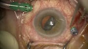 Dislocated Lens