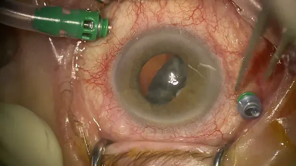 Dislocated Lens thumbnail