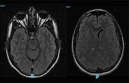 Reversible Cortical Blindness Secondary to Acute Carbon Monoxide Poisoning image