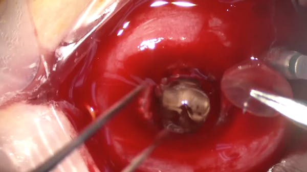 Suprachoroidal Hemorrhage thumbnail