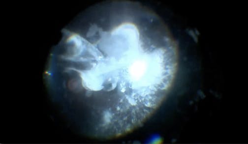 Subretinal Triamcinolone