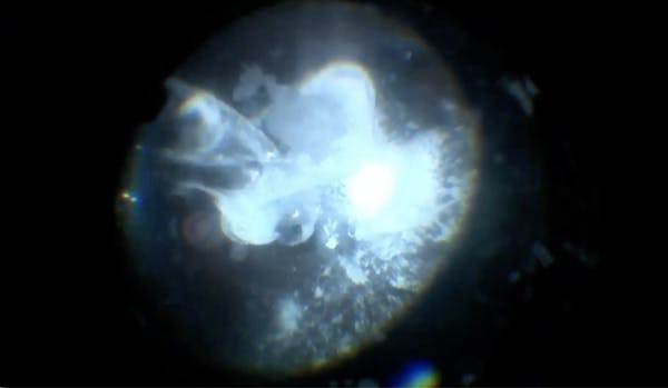 Subretinal Triamcinolone thumbnail