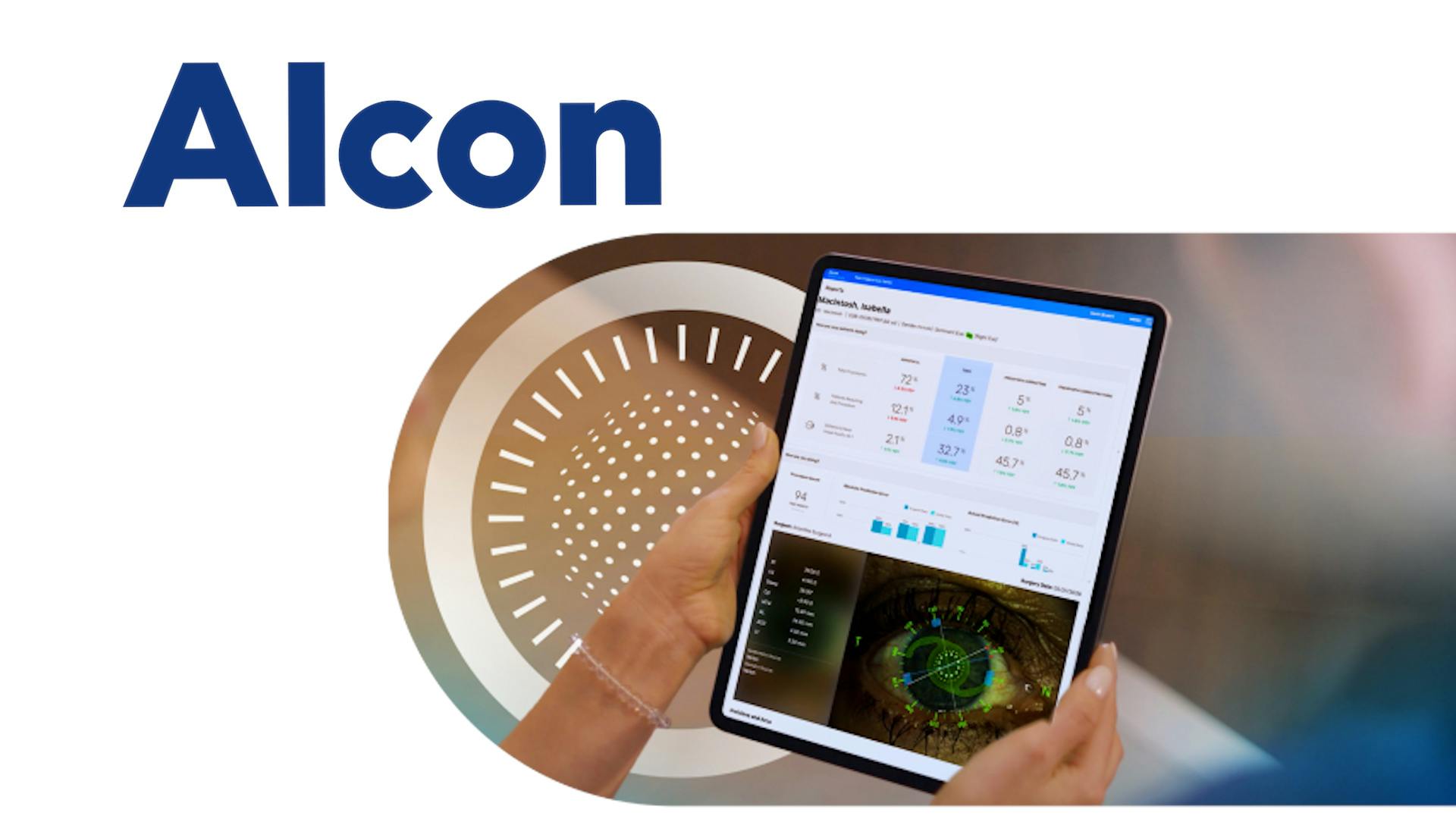 Alcon SMARTCataract DX Eyewire+