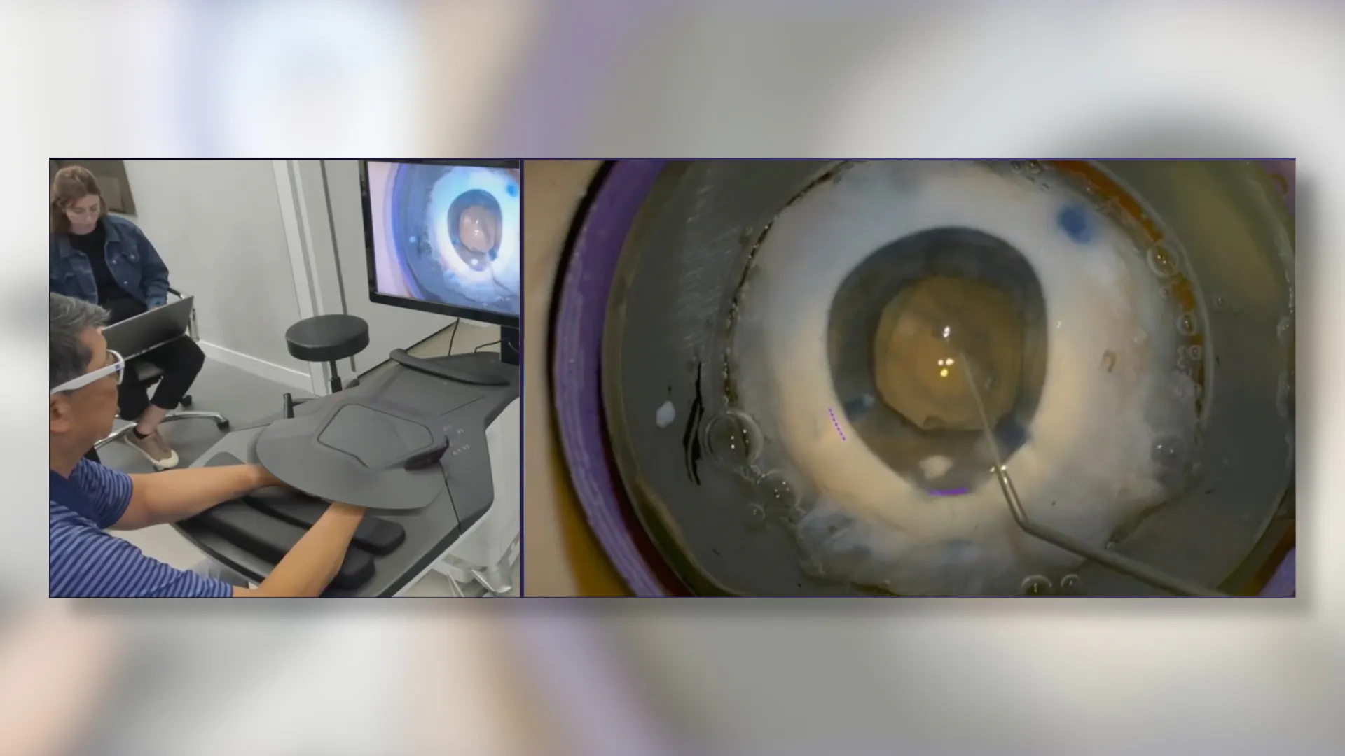 Robotic Cataract Surgery Performed on a Porcine Eye - Eyewire+