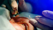 Cataract Surgery Medicare Payment thumbnail
