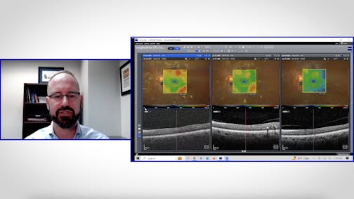 Using ZEISS Retina Workplace for patient compliance: A longitudinal case of Macular Edema & Diabetic Retinopathy