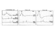 CIDP in an Adolescent After Pfizer-BioNTech COVID-19 Vaccination image