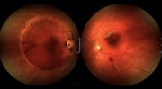 Vitreous Hemorrhage