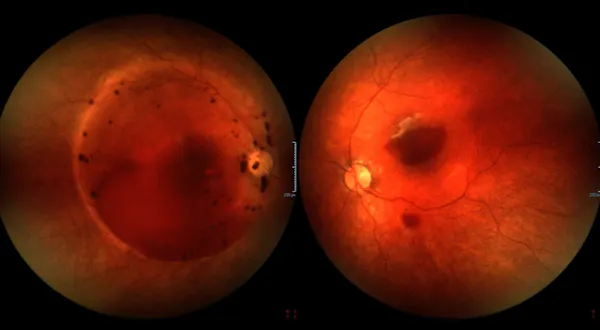 Vitreous Hemorrhage thumbnail