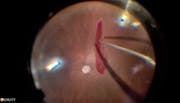 Retrobulbar Anesthesia