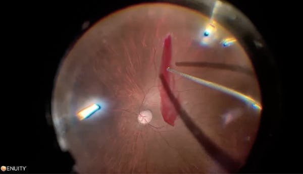 Retrobbulbar Anesthesia thumbnail