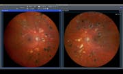 Simplifying Diabetic Retinopathy Follow-Up Over the Years with ZEISS Retina Workflow