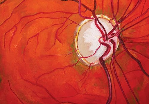 Forward Progress in Glaucoma Management image