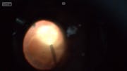 Retinal Detachment