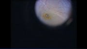 Subfoveal Perfluoron