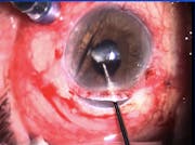 P. Acne Endophthalmitis