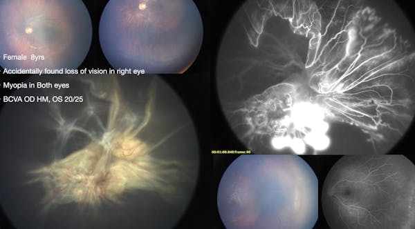 PVR in a Child thumbnail