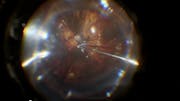 Recurrent Macular Hole in High Myopia