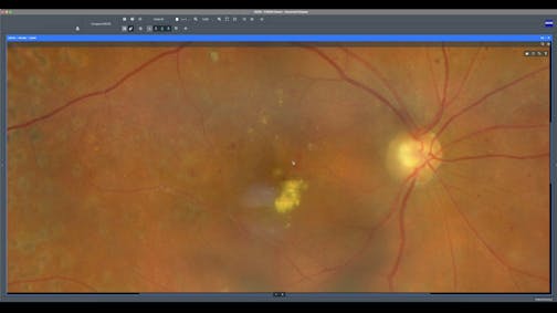 Targeting TelCap in Diabetic Retinopathy: Precision Imaging and Treatment with ZEISS Retina Workflow Solutions