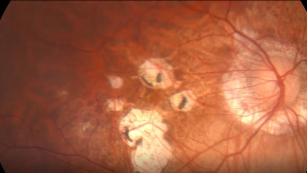 High Myopia and Macular Hole thumbnail