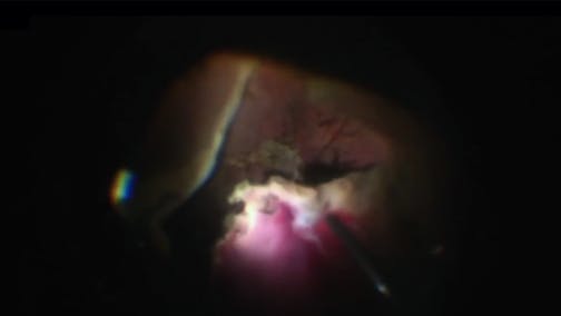 Retinal Fold and Incarceration Trauma