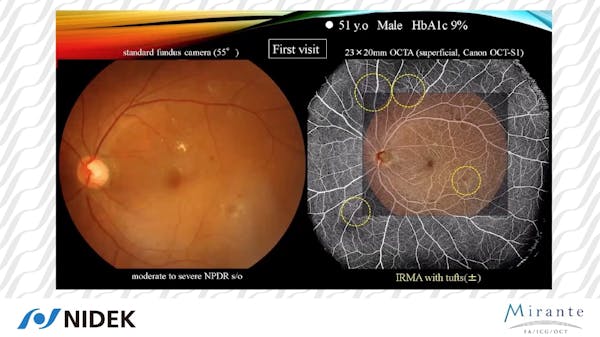Expert Experience with Multimodal Imaging - A Deep Dive Into Wider Retinal Imaging thumbnail
