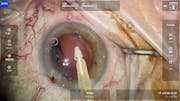 ZEISS QUATERA 700 Cataract Removal plus ZEISS CT LUCIA 621P Implant