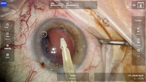 ZEISS QUATERA 700 Cataract Removal plus ZEISS CT LUCIA 621P Implant