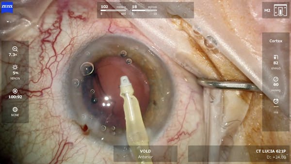 ZEISS QUATERA 700 Cataract Removal plus ZEISS CT LUCIA 621P Implant thumbnail